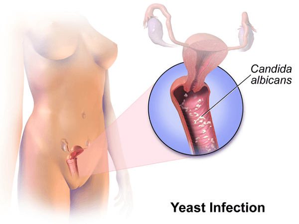 yeast infection